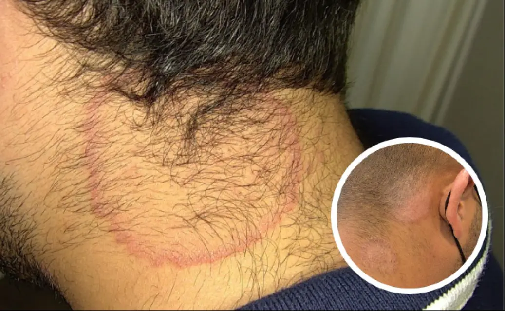 ¡Increíble! Acecha brote de tiña en peluquerías